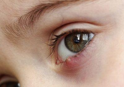 Styes and chalazia: Differences and risks