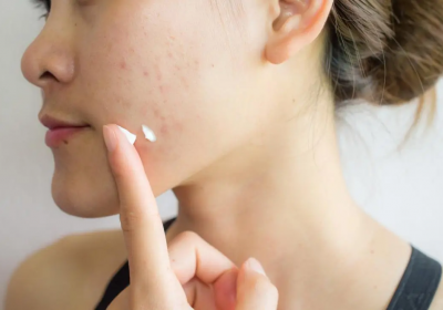 How To Get Rid of Acne Scars Easily?