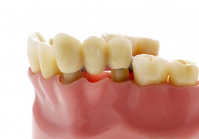 Dental Bridges: Understanding the 4 Types