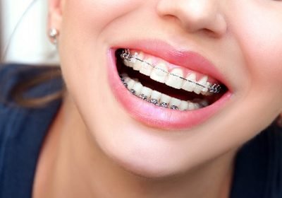 Signs That Will Tell You That You Need to Consider Braces Again