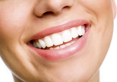 Teeth Whitening in Columbia: What are Your Options?
