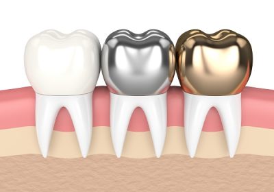 Do You Know a Dental Crown in Winnipeg? How to Know?