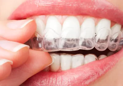 What Are the Benefits of Tooth Whitening?