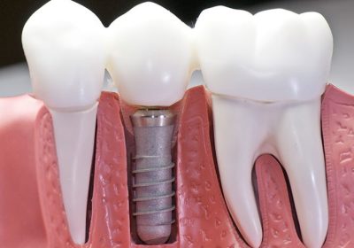 Are Dental Implants in Maryville, TN, Worth the Cost?