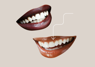 How Should You Take Care of Veneers?