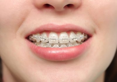 Ways to Make Your Braces Less Noticeable 