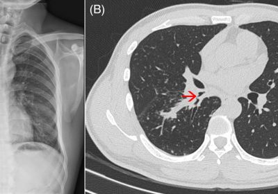 Understanding the Link Between Asthma, Allergies, and Tuberculosis in the Chest