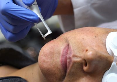 Evaluating Pico Laser Price for Aesthetic Treatments