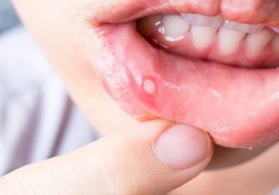 Understanding Ulcers: Exploring Different Types And Their Implications