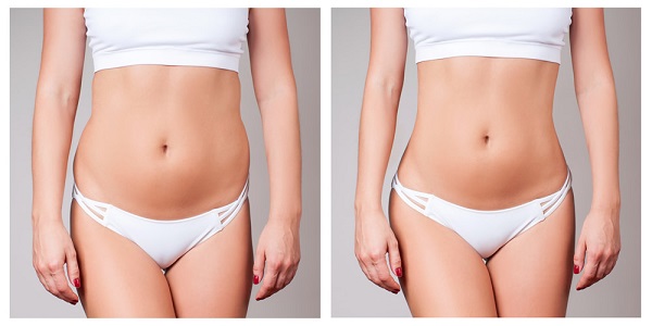  does CoolSculpting tighten skin